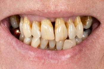 All on 4 İmplant Öncesi