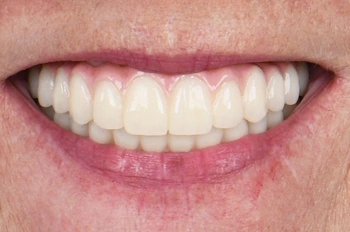 All on 4 İmplant Sonrası