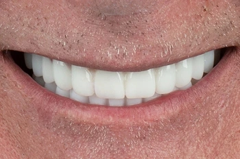 All on 6 İmplant Sonrası