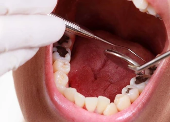 Diş Siniri Ölmesi Nedir, Neden Olur ve Nasıl Tedavi Edilir?